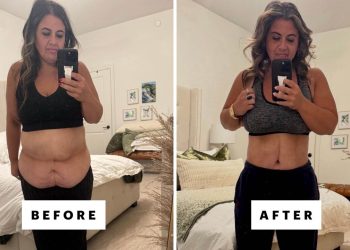 I Got Skin Removal Surgery After Losing 230 Pounds On a GLP-1