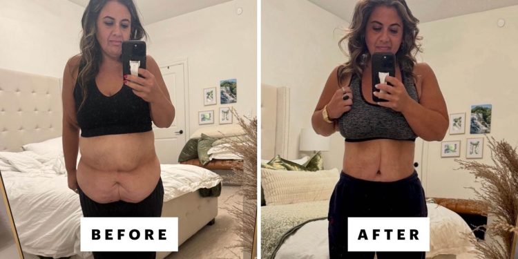 I Got Skin Removal Surgery After Losing 230 Pounds On a GLP-1