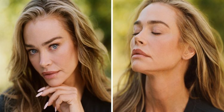 Denise Richards Shares Facelift Results With Before-and-After Photos