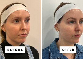 XERF Is the New Non-Invasive Skin-Tightening Device Gaining Popularity in the US, and I Tried It—Review, Photos