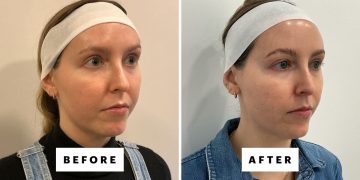 XERF Is the New Non-Invasive Skin-Tightening Device Gaining Popularity in the US, and I Tried It—Review, Photos