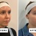 XERF Is the New Non-Invasive Skin-Tightening Device Gaining Popularity in the US, and I Tried It—Review, Photos