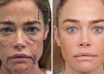 Denise Richards’ Raw Facelift Before-and-After Photos Are the Transparency We Need