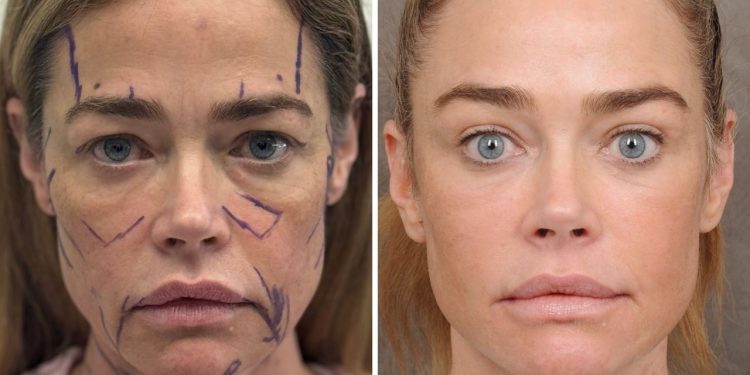 Denise Richards’ Raw Facelift Before-and-After Photos Are the Transparency We Need