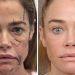 Denise Richards’ Raw Facelift Before-and-After Photos Are the Transparency We Need