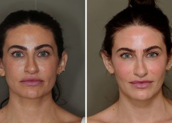 I Tried Facial Fat Grafting and 6 Months Later, I’m Very Into My Results