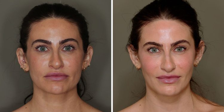I Tried Facial Fat Grafting and 6 Months Later, I’m Very Into My Results