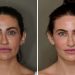 I Tried Facial Fat Grafting and 6 Months Later, I’m Very Into My Results