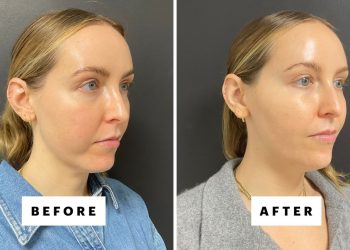 I Got Chin Filler for the First Time—See the Before-and-After Photos