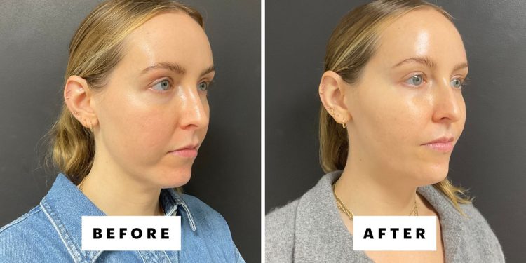 I Got Chin Filler for the First Time—See the Before-and-After Photos