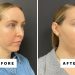 I Got Chin Filler for the First Time—See the Before-and-After Photos