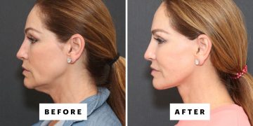 The Trending Procedure That Can Restore Your 25-Year-Old Jawline—With Before and After Photos