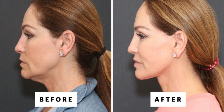 The Trending Procedure That Can Restore Your 25-Year-Old Jawline—With Before and After Photos
