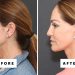The Trending Procedure That Can Restore Your 25-Year-Old Jawline—With Before and After Photos