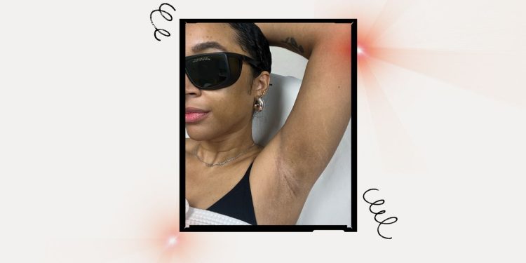 How I’m Preventing Hyperpigmentation During Laser Hair Removal