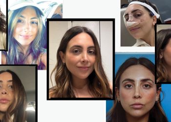 I Got a Revision Rhinoplasty to Fix My Nose Job—Before & After Photos