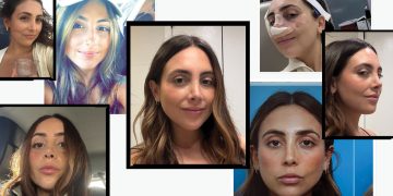 I Got a Revision Rhinoplasty to Fix My Nose Job—Before & After Photos