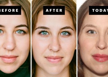 My Rhinoplasty Procedure Story | Nose Before and After Photos