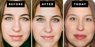 My Rhinoplasty Procedure Story | Nose Before and After Photos