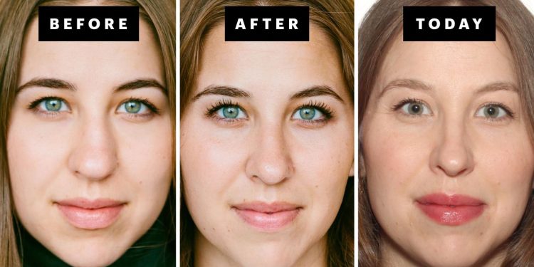 My Rhinoplasty Procedure Story | Nose Before and After Photos