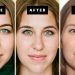 My Rhinoplasty Procedure Story | Nose Before and After Photos