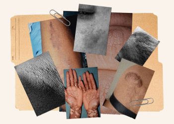 11 Common Skin Conditions on Dark Skin and How to Treat Them
