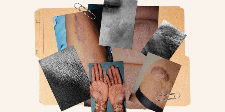 11 Common Skin Conditions on Dark Skin and How to Treat Them