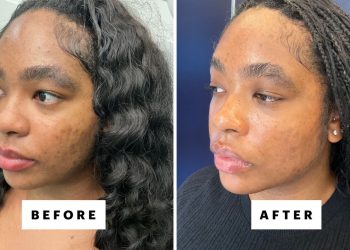 Does Laser Genesis Really Live Up to the Hype?