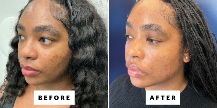 Does Laser Genesis Really Live Up to the Hype?
