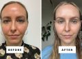 Can You Use Azelaic Acid With Tretinoin? Dermatologists Weigh In.