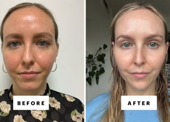 Can You Use Azelaic Acid With Tretinoin? Dermatologists Weigh In.