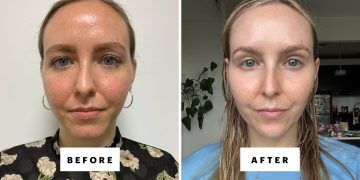 Can You Use Azelaic Acid With Tretinoin? Dermatologists Weigh In.
