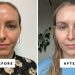 Can You Use Azelaic Acid With Tretinoin? Dermatologists Weigh In.