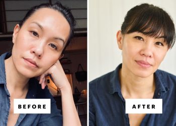 What Happened After I Quit Botox, Fillers, Lasers, and GLP-1s