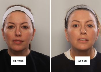 Can You Fake a Blepharoplasty? I Gave It My Best Shot