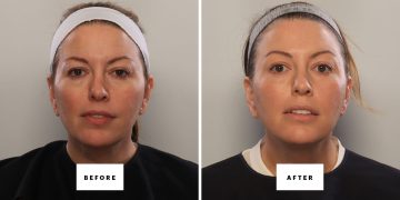 Can You Fake a Blepharoplasty? I Gave It My Best Shot