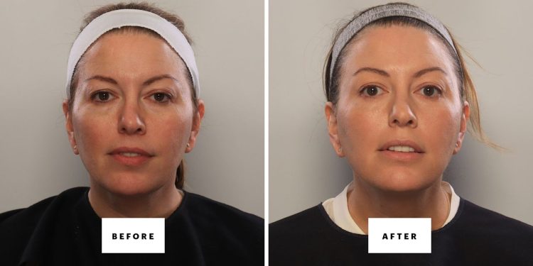 Can You Fake a Blepharoplasty? I Gave It My Best Shot
